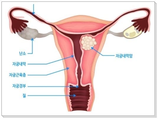 자궁경부암 검사 무료대상 1